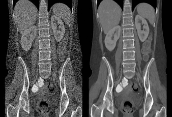 Image: The image at left demonstrates filtered back projection (FBP) image reconstruction using conventional CT imaging, and, at right, an image reconstruction using Veo. Developed by Purdue University, University of Notre Dame and GE Healthcare, Veo is a new CT scanning technology that enables physicians to diagnose patients with high clarity images at previously unattainable low radiation dose levels (Photo courtesy of Purdue University).